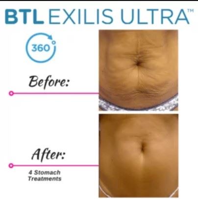 A before and after picture of the stomach area.