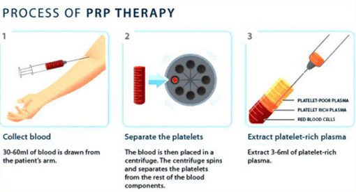 A diagram of how to use the prp therapy.