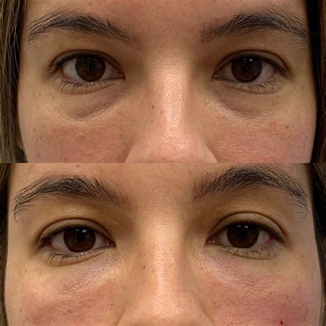 A before and after picture of the same woman 's eyes.