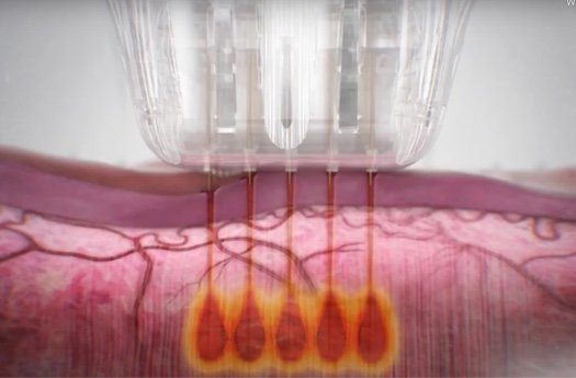 Skin treatment with four heated needles.